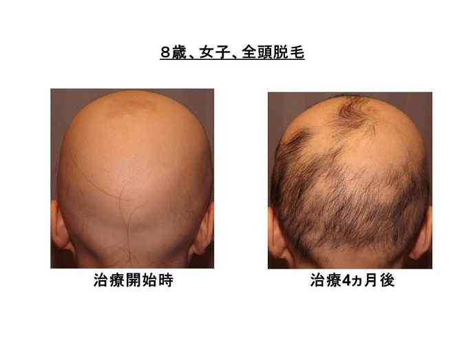 円形脱毛症　病院""